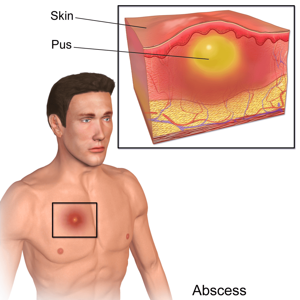 ပြည်တည်နာ (ခူနာ)|Abscess – MM How Health